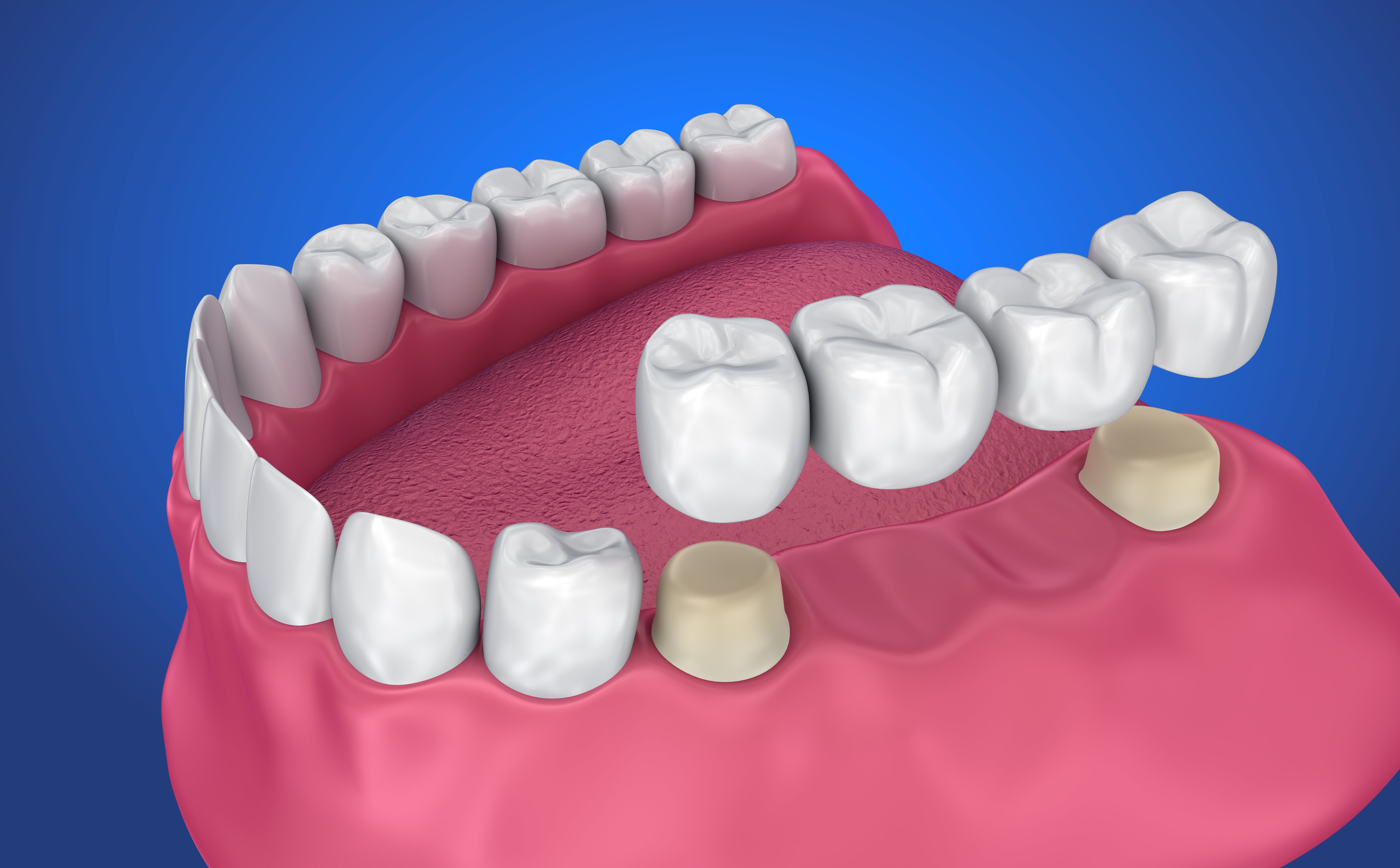 Toothwise Dental Clinic Crown, Caps, Bridges & Prosthodontics