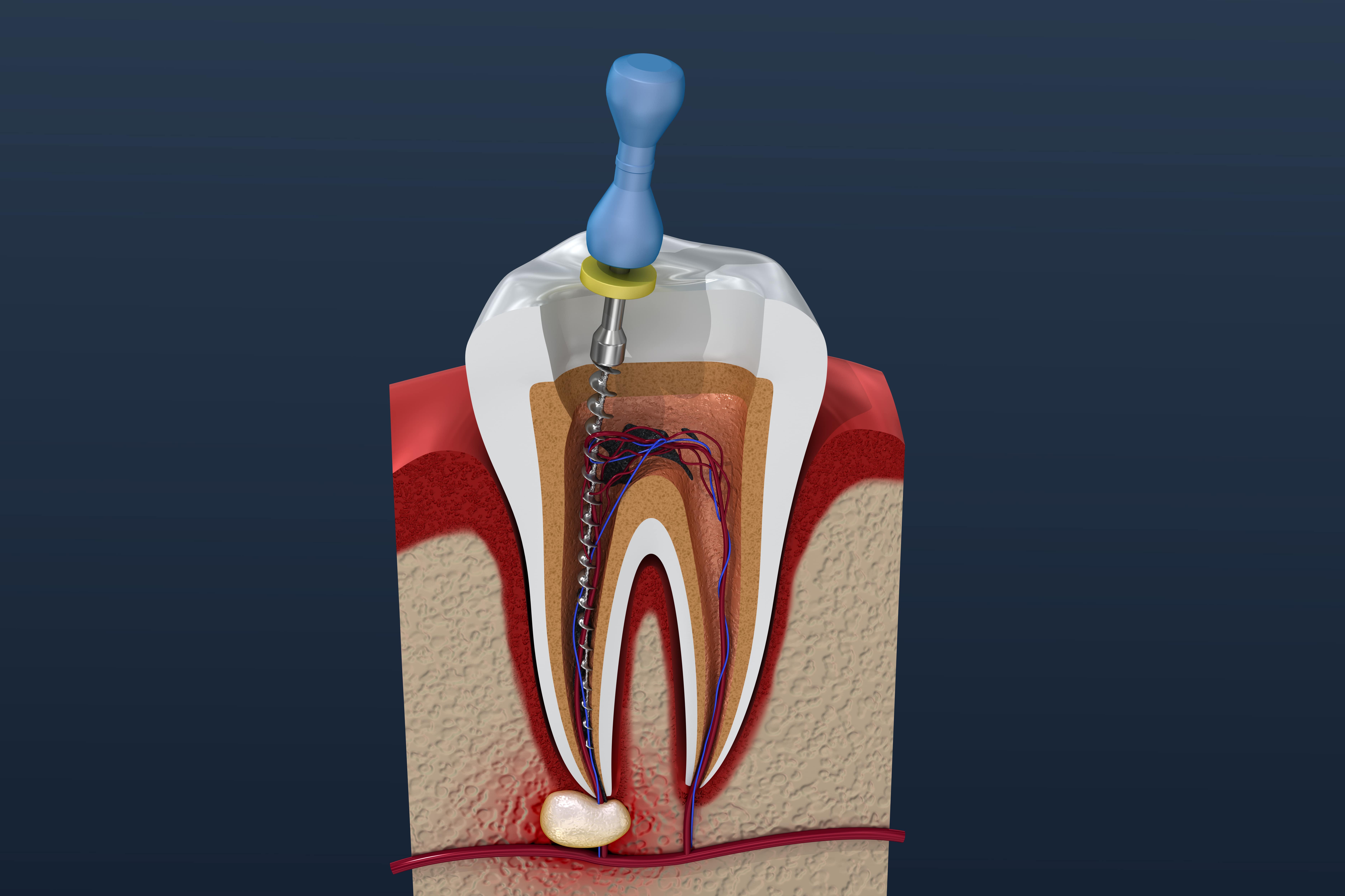 Toothwise Dental Clinic Root Canal