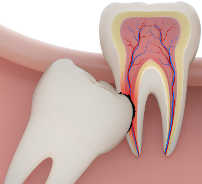 Toothwise Dental Clinic Wisdom Tooth Extraction